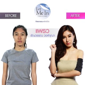 01 _ Thanyawan “Praew” Wongkuna surgery