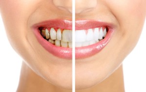 Here's How To Cure Gingivitis With Coconut Oil, Turmeric, Lemons Or Baking Soda – Without Dentist