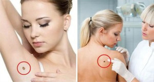 how to remove papilloma virus