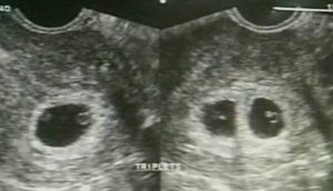 Sara Ultrasound