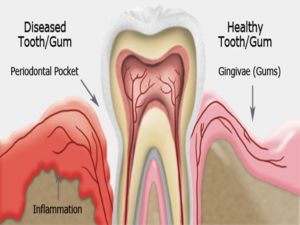 Gum diseases