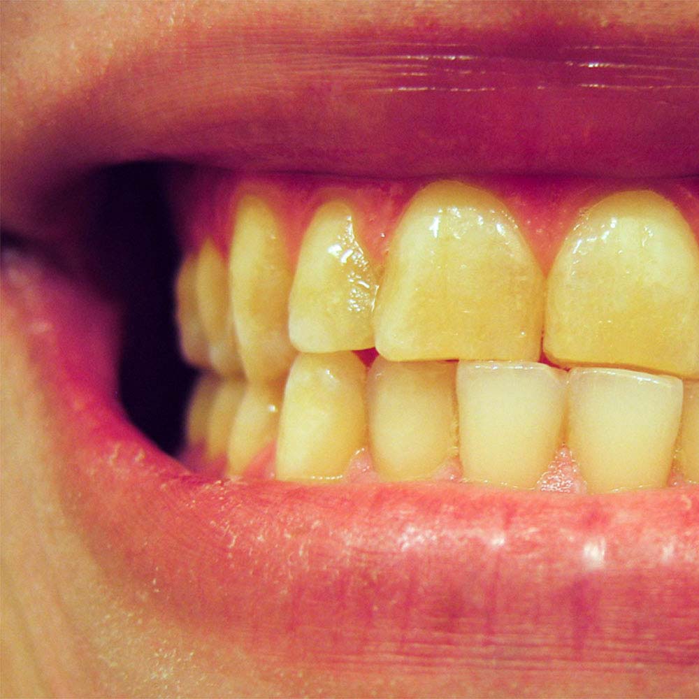 yellowish-teeth-treatment-5-ways-to-whiten-yellowish-teeth