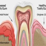 Gum disease