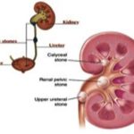 kidney stone