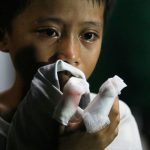 Firecracker Casualties