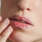 dry lips chapped lips