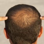 hair loss causes treatment solutions