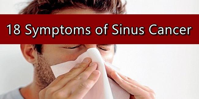 Sinus Cancer Symptoms | NewsFeed