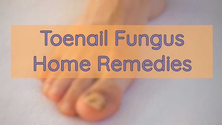 TOENAIL FUNGUS: 10 Home Remedies To Treat This Problem