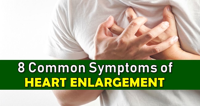 Heart Enlargement Symptoms - 8 Warning Signs Of Mild Cardiomegaly