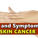 Skin Cancer Symptoms