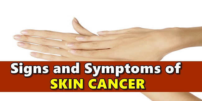 SKIN CANCER SYMPTOMS - Signs That You Need To Go For Check-Up
