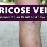 Varicose Veins Causes, How to Avoid It