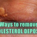 cholesterol deposits