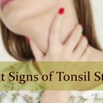 tonsil stones