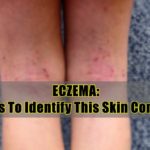 eczema