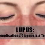 lupus