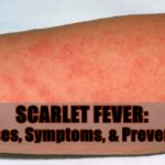 scarlet fever
