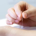 acupuncture