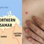 Mpox Case In The Philippines